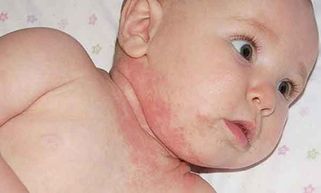 Bé bị chàm sữa - Mẹo trị chàm sữa cho bé an toàn lành tính tại nhà