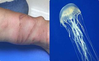 Cẩn trọng nếu bị sứa cắn khi đi tắm biển, xử lý sao cho đúng?