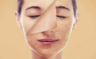 Da mặt sần sùi vì bị mụn phải làm sao? Cách điều trị đơn giản nhanh, hiệu quả nhất