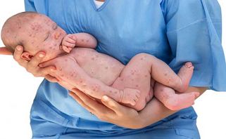 Bệnh Rubella: nguyên nhân, con đường lây truyền và dấu hiệu nhận biết