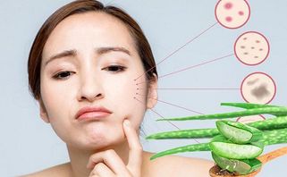 Top 13 cách trị mụn thâm mờ nhanh, da sáng mịn sau 1 tuần