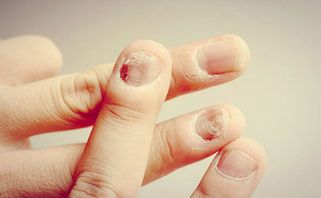 Bệnh nấm móng tay là gì? Nguyên nhân, triệu chứng và cách điều trị?
