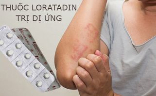 Thuốc Loratadin trị dị ứng: công dụng và cách sử dụng 