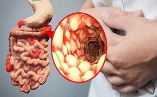 Bệnh Crohn là gì? Có nguy hiểm không? Triệu chứng và Cách điều trị?
