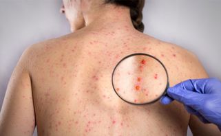 Bệnh zona thần kinh là gì? Có lây không? Triệu chứng và cách điều trị?