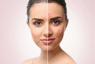 Review: Top 7 kem trị thâm mụn tại nhà hiệu quả nhất, được dùng nhiều nhất mọi thời đại