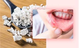 Tổng hợp 12 cách chữa nhiệt miệng hiệu quả nhanh chóng