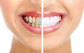 Tổng hợp 7749 cách làm trắng răng tại nhà nhanh, hiệu quả, an toàn nhất 2021