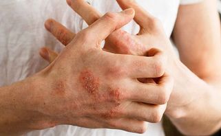 Tổng quan về bệnh chàm: nguyên nhân, biểu hiện và biện pháp điều trị