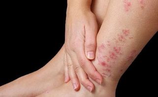 Dấu hiệu nhận biết 5 bệnh nấm da thường gặp tại Việt Nam 