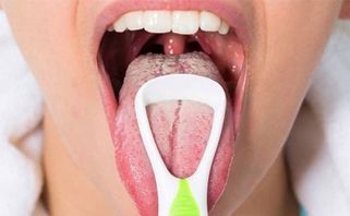 Lưỡi trắng là do đâu? Có phải mắc bệnh không? Phòng ngừa như thế nào?