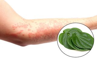 Nổi mẩn ngứa toàn thân: nguyên nhân và cách điều trị bạn cần biết