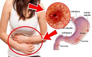 Tá tràng là gì? Nguyên nhân và triệu chứng viêm loét dạ dày tá tràng 