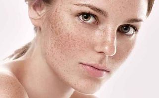 Đồi mồi là gì? Có thể điều trị được đồi mồi hay không? Điều trị như thế nào?
