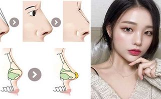 Nâng mũi cấu trúc: ưu, nhược điểm và những thông tin cần nắm rõ 