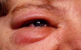 Phù Quincke là gì? Tại sao dễ nhầm lẫn với nổi mề đay?