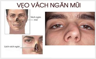 Vẹo vách ngăn mũi là gì? Có nguy hiểm không? Khi nào cần phẫu thuật?