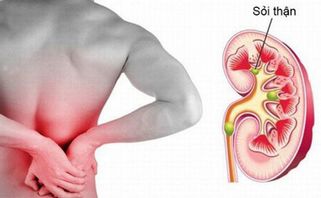 Bệnh sỏi thận: nguyên nhân, triệu chứng và cách phòng