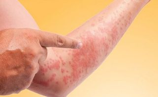 Top 10 thuốc chữa mề đay, dị ứng mẩn ngứa hiệu quả nhanh chóng