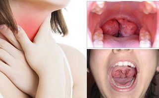 Top 10 thuốc chữa viêm amidan cấp, mãn tính được bác sĩ khuyên dùng