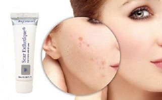 Top 15 kem trị sẹo thâm tốt nhất và cách sử dụng hiệu quả