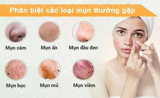 Cách nhận biết các loại mụn thường gặp và cách trị mụn hiệu quả