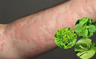 18 cách trị mề đay tại nhà hiệu quả GIẢM NGỨA NHANH