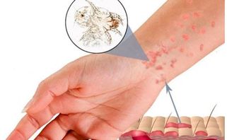Ghẻ nước là bệnh gì? Nguyên nhân, triệu chứng và cách điều trị