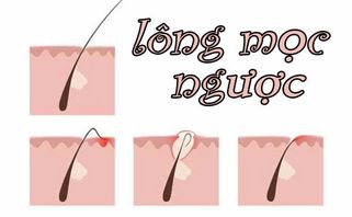 Lông mọc ngược phải làm sao? Cách xử lý an toàn và ngăn chặn lông mọc ngược