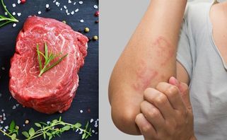 Dị ứng thịt bò phải làm sao? Dấu hiệu nhận biết và cách xử lý kịp thời?