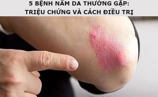 5 loại bệnh nấm da thường gặp: triệu chứng và cách điều trị