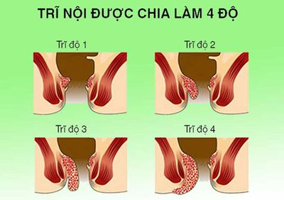 Hỗ trợ trĩ